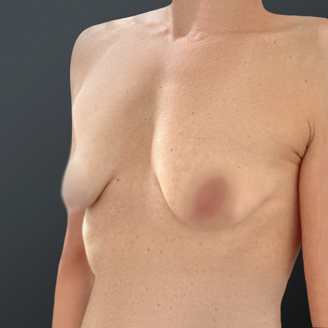 ПХ. Волох. Маммопластика, подтяжка груди (вертикальная мастопексия) на имплантатах 9