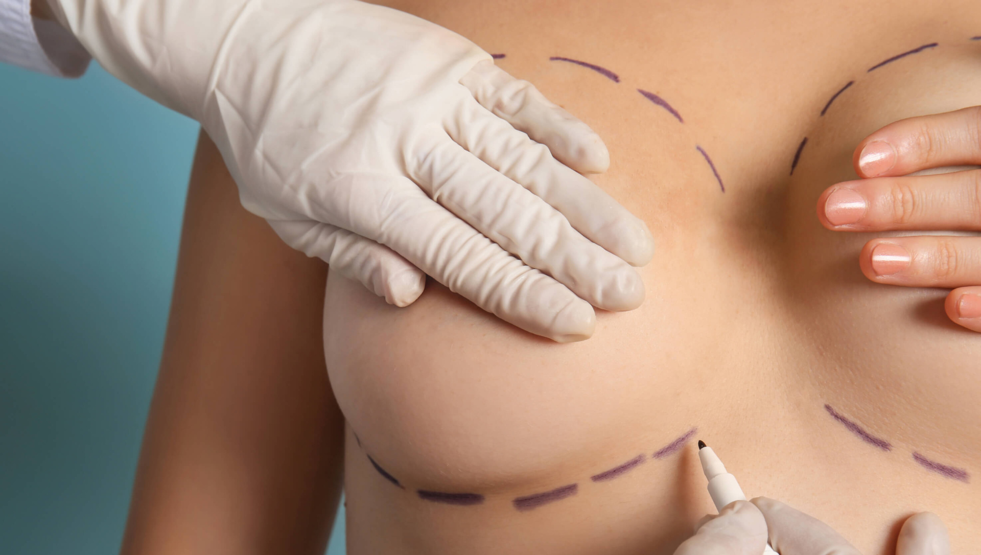 Как проходит операция по уменьшению груди
