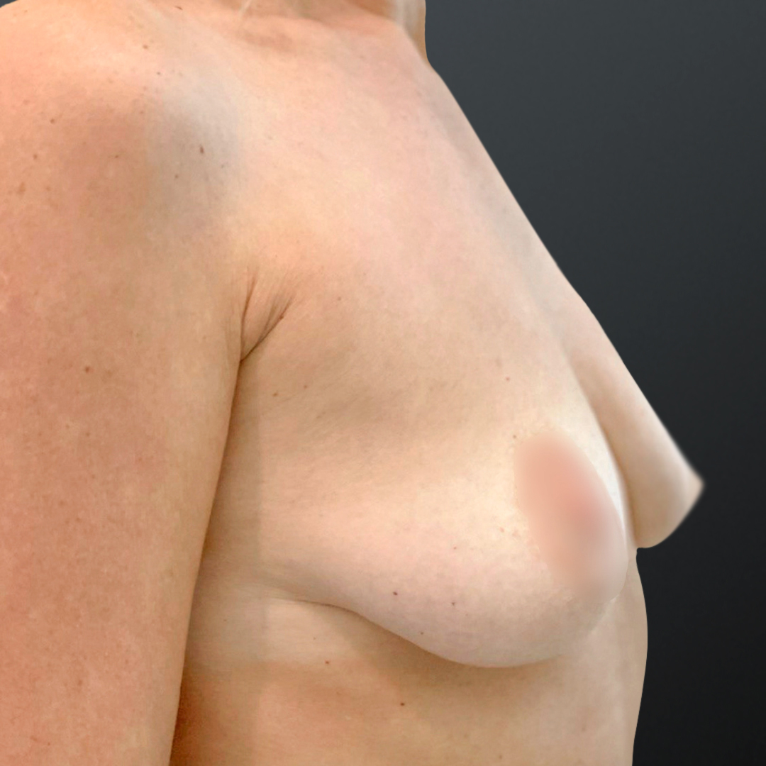 ПХ. Волох. Маммопластика, подтяжка груди (молочных желез) на импланте 1