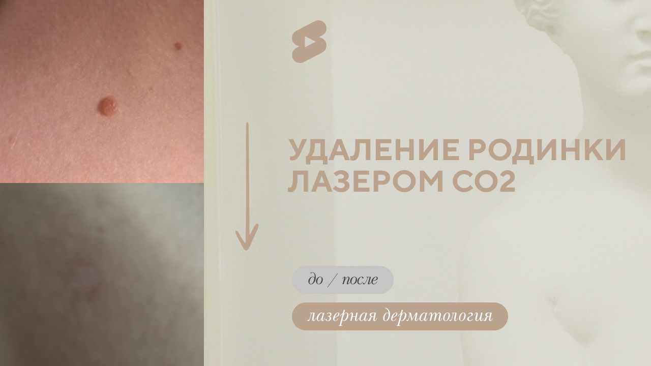 Удаление родинки лазером CO2 (Чистякова О.А.)