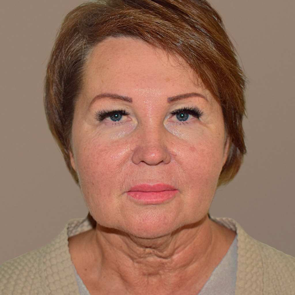 ПХ. Парыгин. Комплексное омоложение. Подтяжка лица, фейслифтинг, платизмопластика, блефаропластика, лобэндоскопия 6
