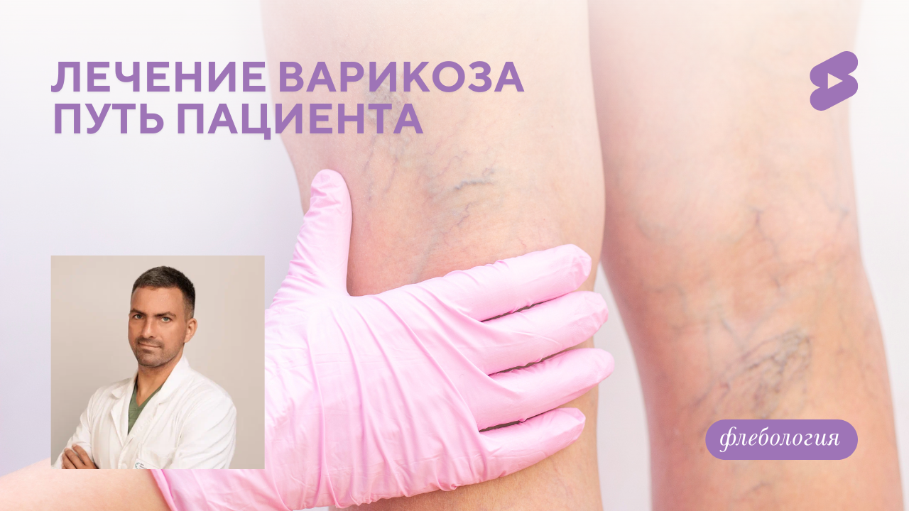 Лечение варикоза, путь пациента (Дука М.Л.)