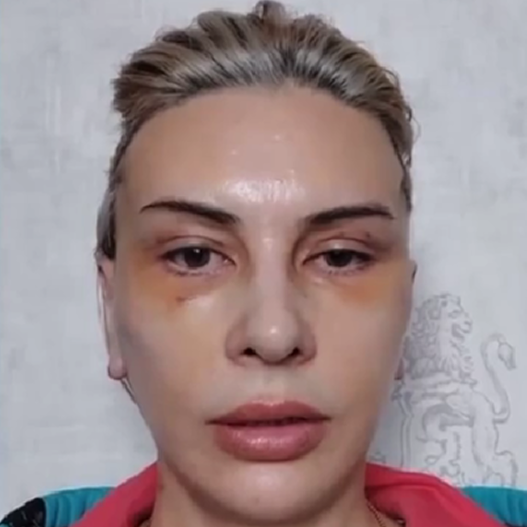 Реабилитация после комплексного омоложения, день 10