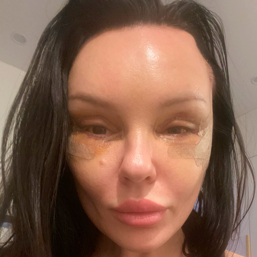 Реабилитация после блефаропластики, <br>4 день