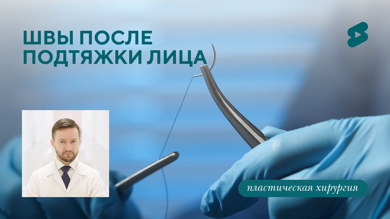 Где располагаются швы после подтяжки лица? (Парыгин Е.А.)