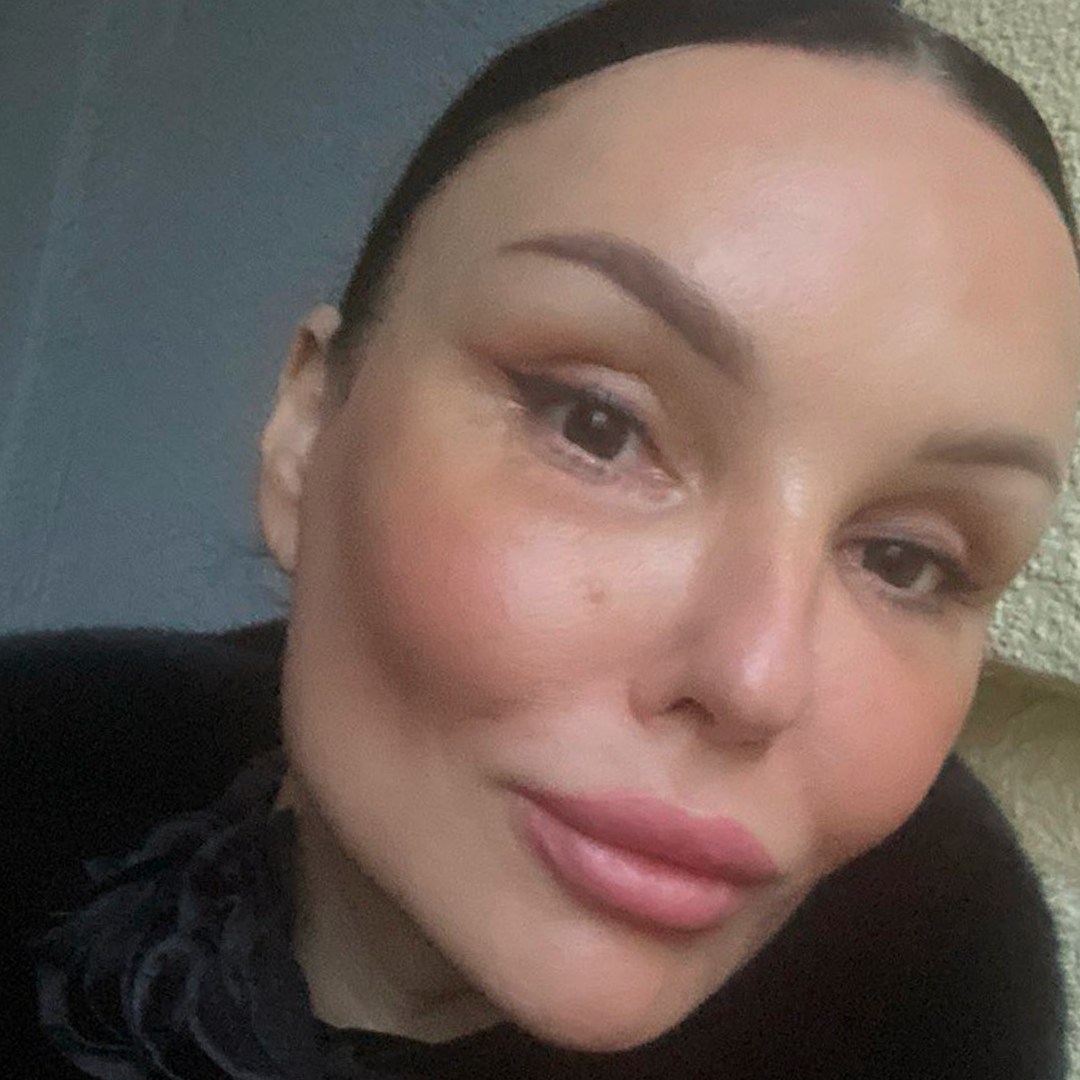 Реабилитация после блефаропластики, <br>9 день