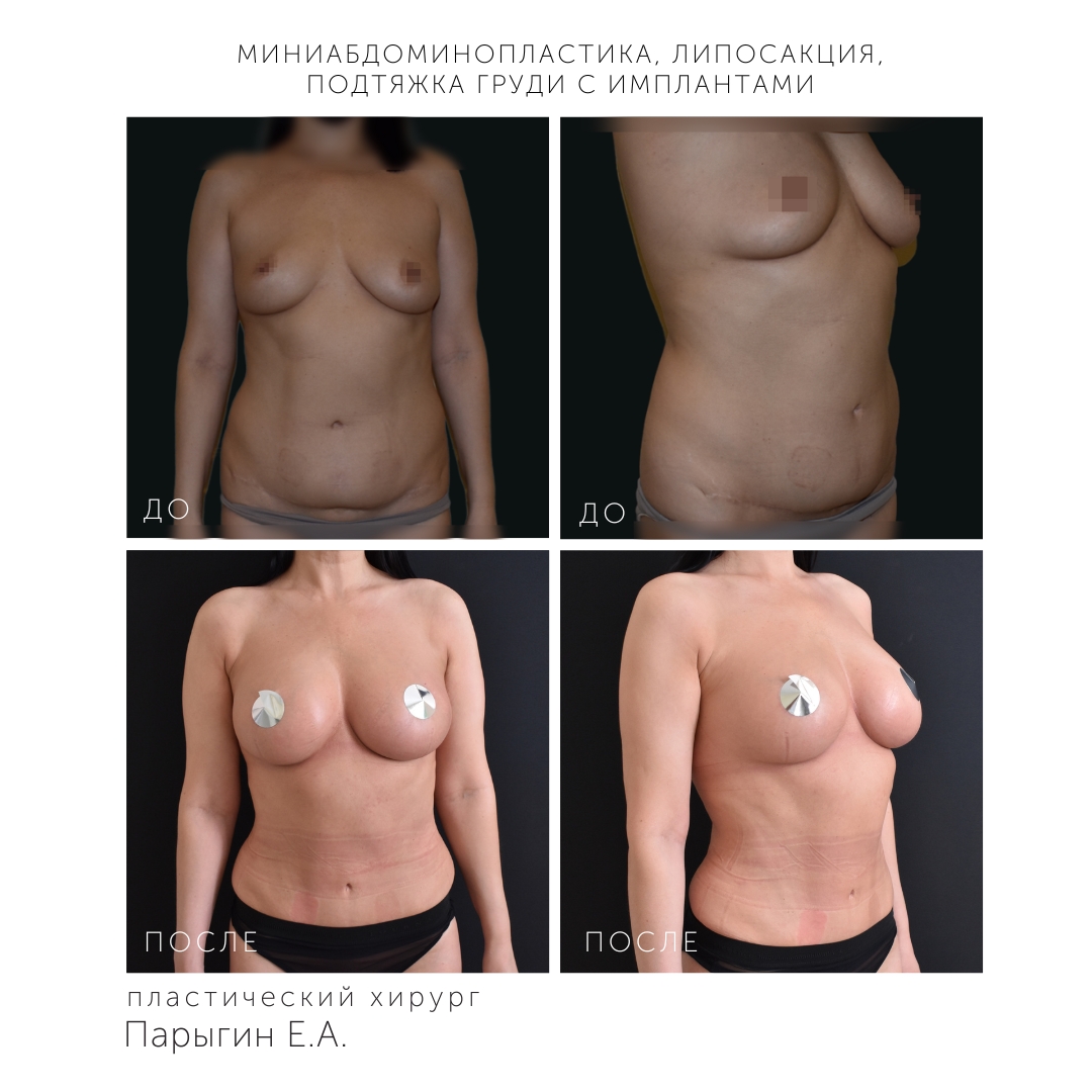 липосакции груди у женщин фото 42