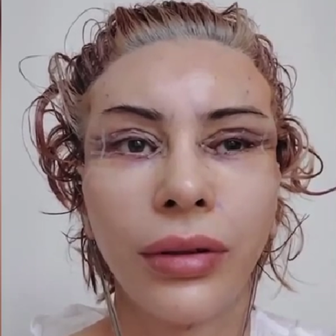 Реабилитация после комплексного омоложения, день 0