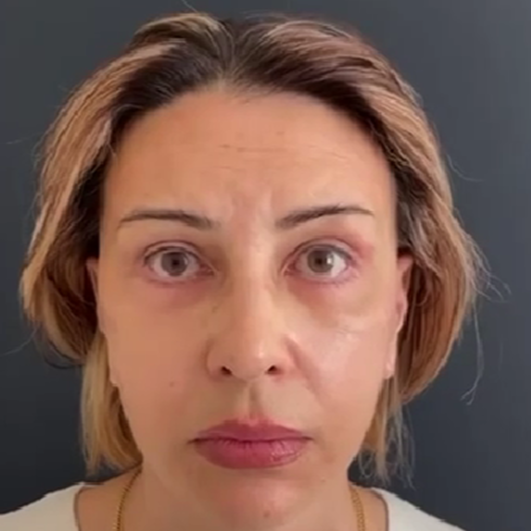 Реабилитация после комплексного омоложения, месяц спустя