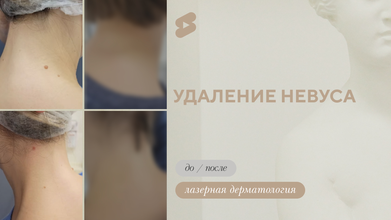 Удаление невуса: что нужно знать? (Чистякова О.А.)
