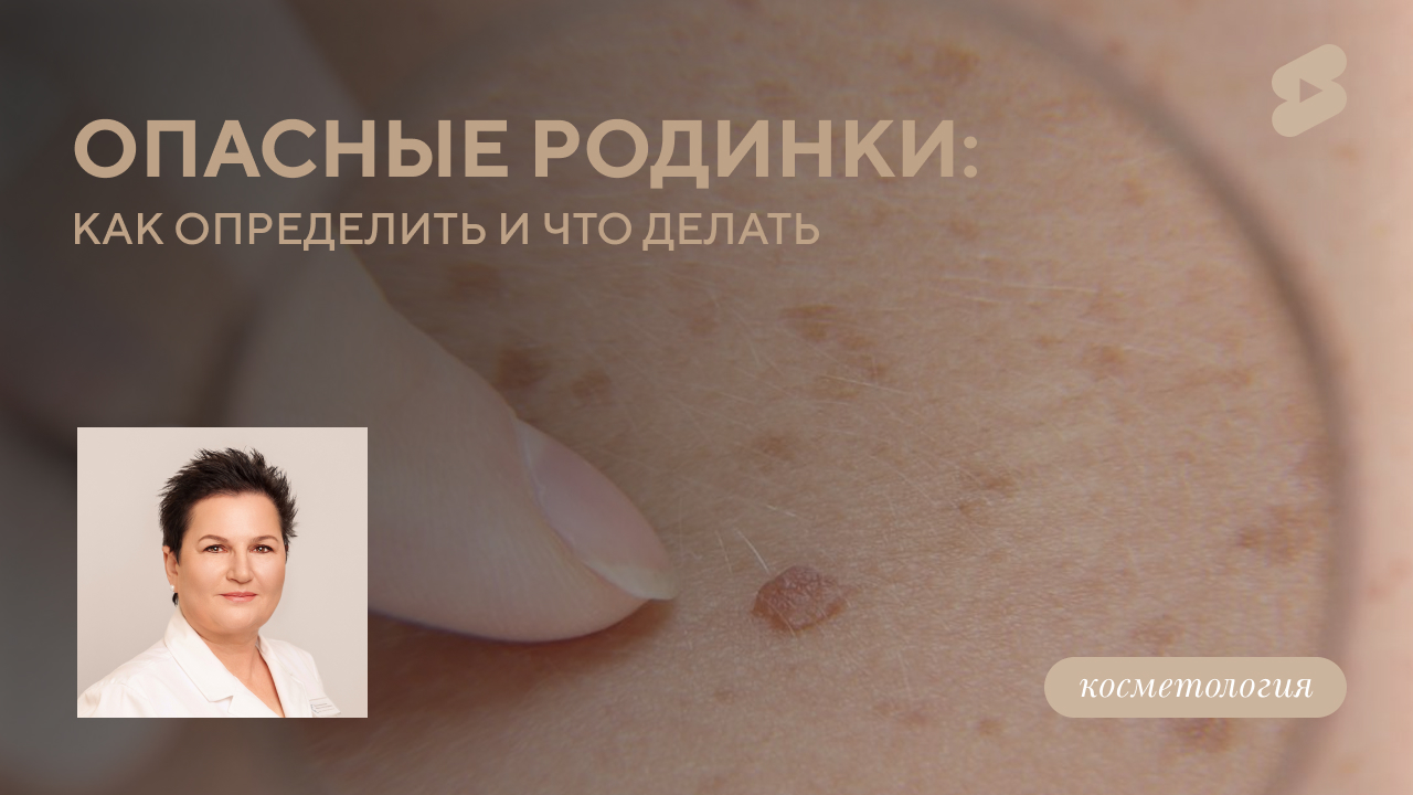 Какие родинки на теле могут представлять опасность? (Оловянишникова И.А.)