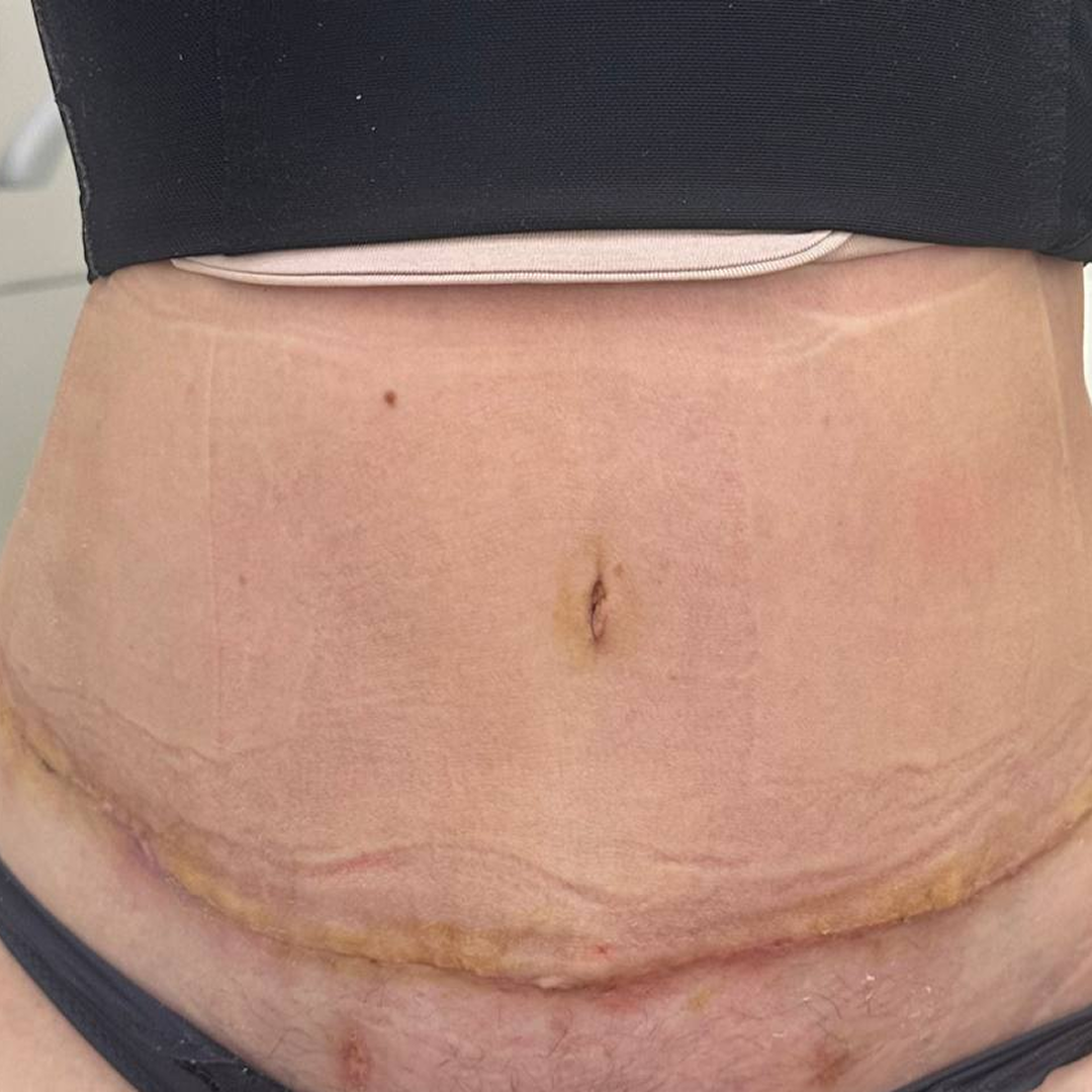 Реабилитация после абдоминопластики с липосакцией, <br> 1 месяц