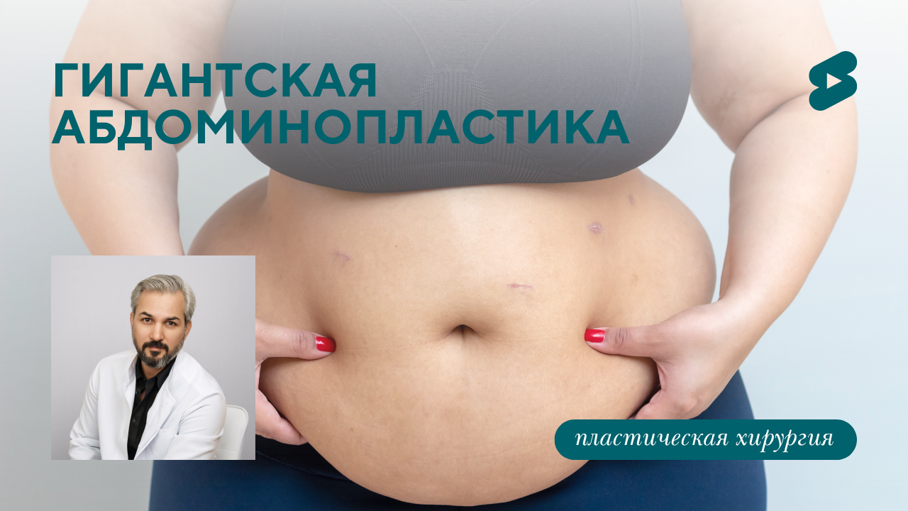Пример гигантской абдоминопластики. (Хатри А.Р.)