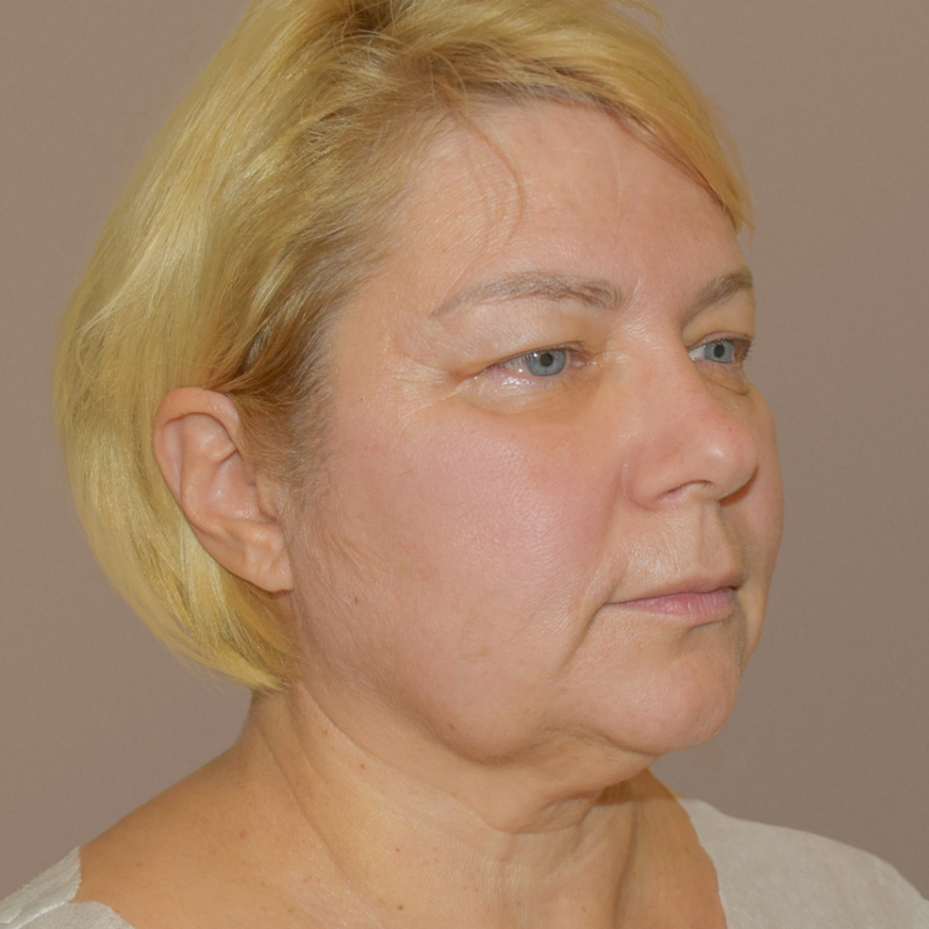 ПХ. Парыгин. Комплексное омоложение, подтяжка лица, фейслифт, платизмопластика, круговая блефаропластика, лобэндоскопия ф2-1