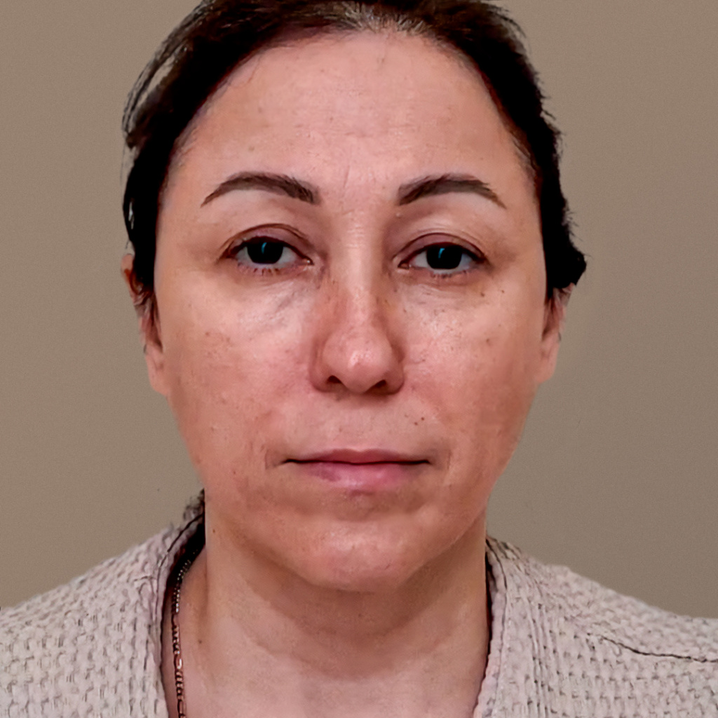 ПХ. Мусафиров. Фейслифтинг, эндоскопический лифтинг, круговая блефаропластика, коррекция кончика носа 6