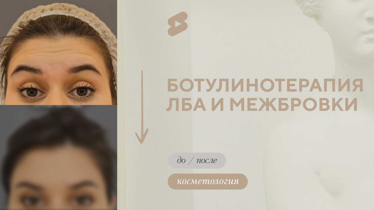 Ботулинотерапия до/после