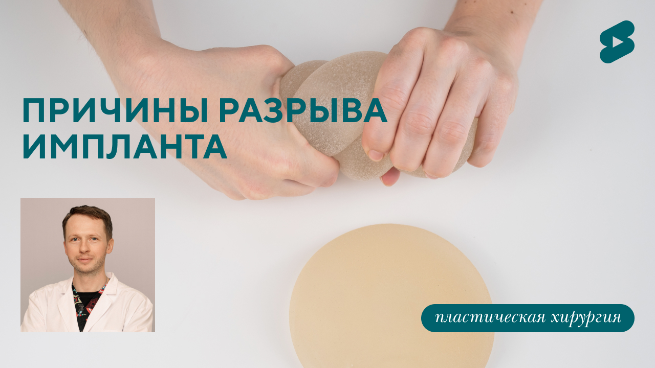 Почему случается разрыв импланта? (Барсаков М.А.)