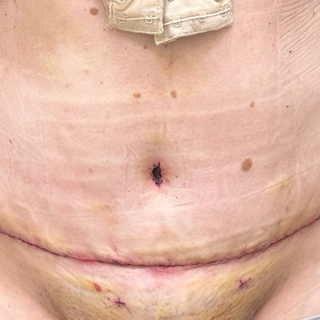 Реабилитация после абдоминопластики с липосакцией и ушиванием диастаза, <br> 7 день