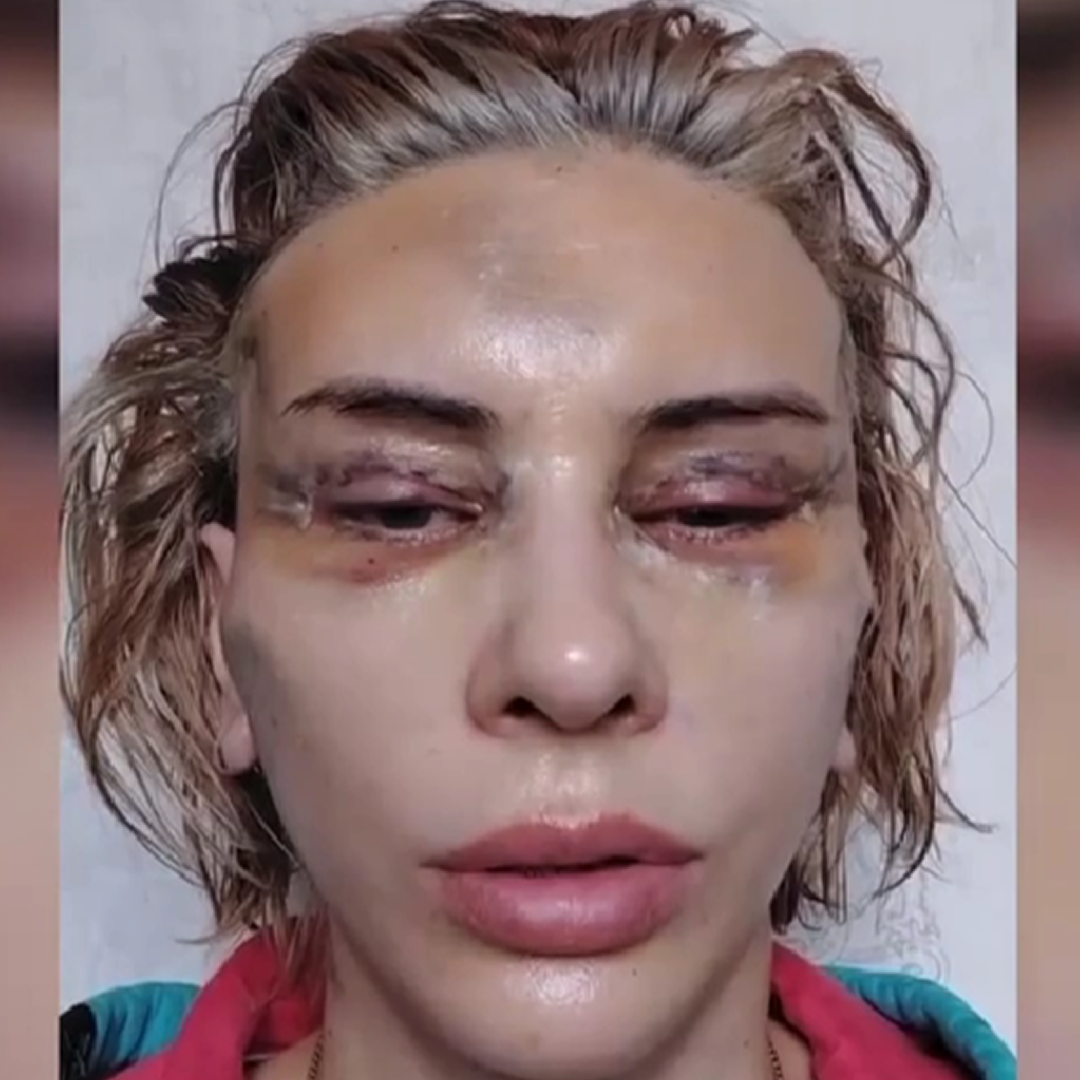 Реабилитация после комплексного омоложения, день 2