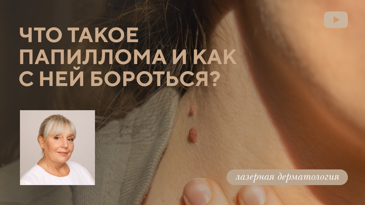 Что такое папиллома и как с ней бороться? (Ластовецкая М.Б.)