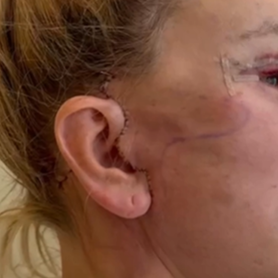 Реабилитация после фейслифтинга, швы на ушах. День 0