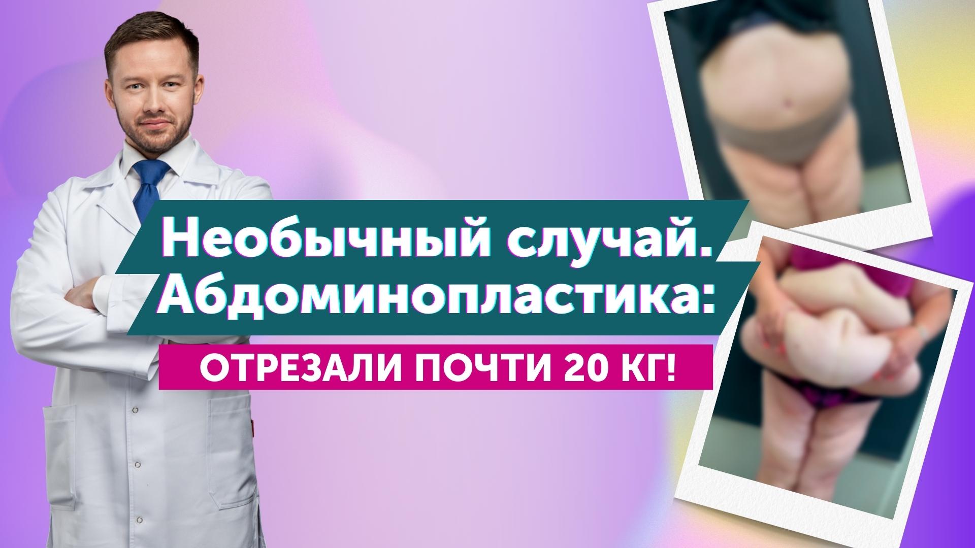 История пациентки Парыгина Е.А. Абдоминопластика