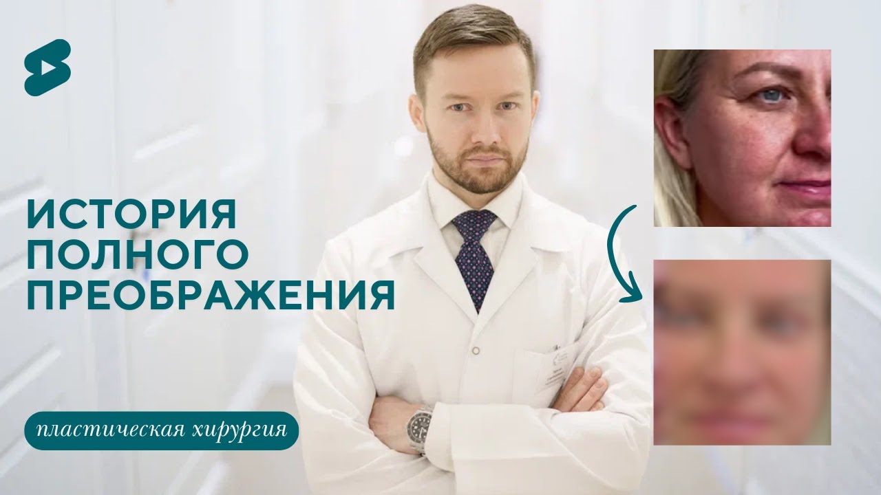Пациентка месяц после подтяжки лица и блефаропластики. Отзыв пациента (Парыгин Е.А.)