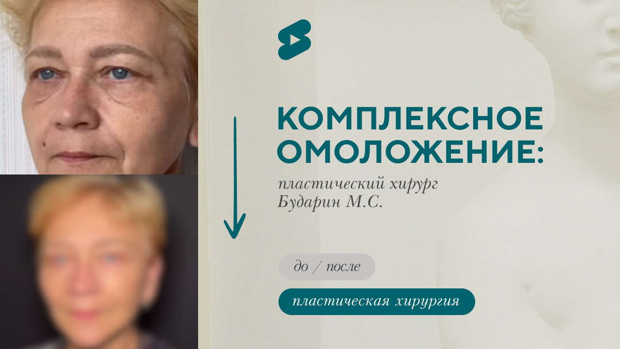 Комплексное омоложение лица, результат через 5 месяцев. До/После (Бударин М.С.)
