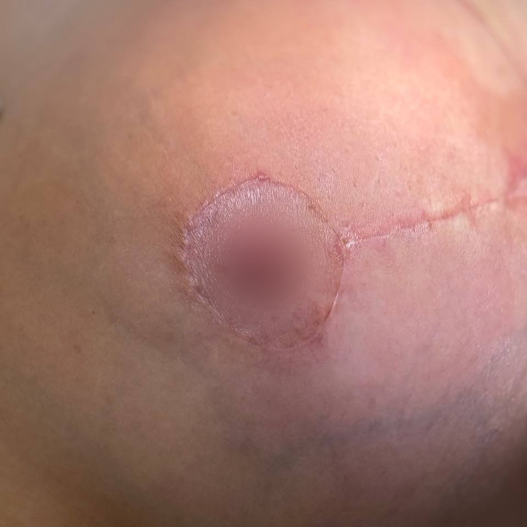 Процесс заживления рубца после операции,<br> 25 день 