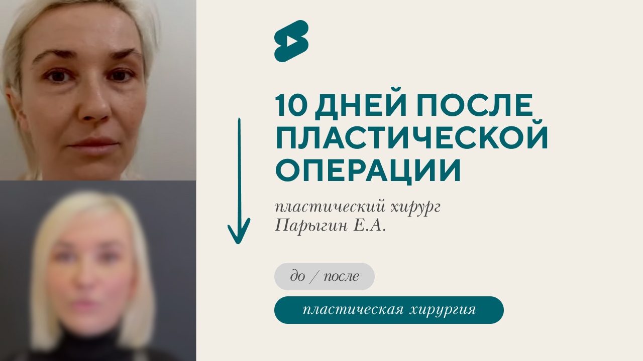 Результат через 10 дней после пластической операции. Отзыв пациента. (Парыгин Е.А.)