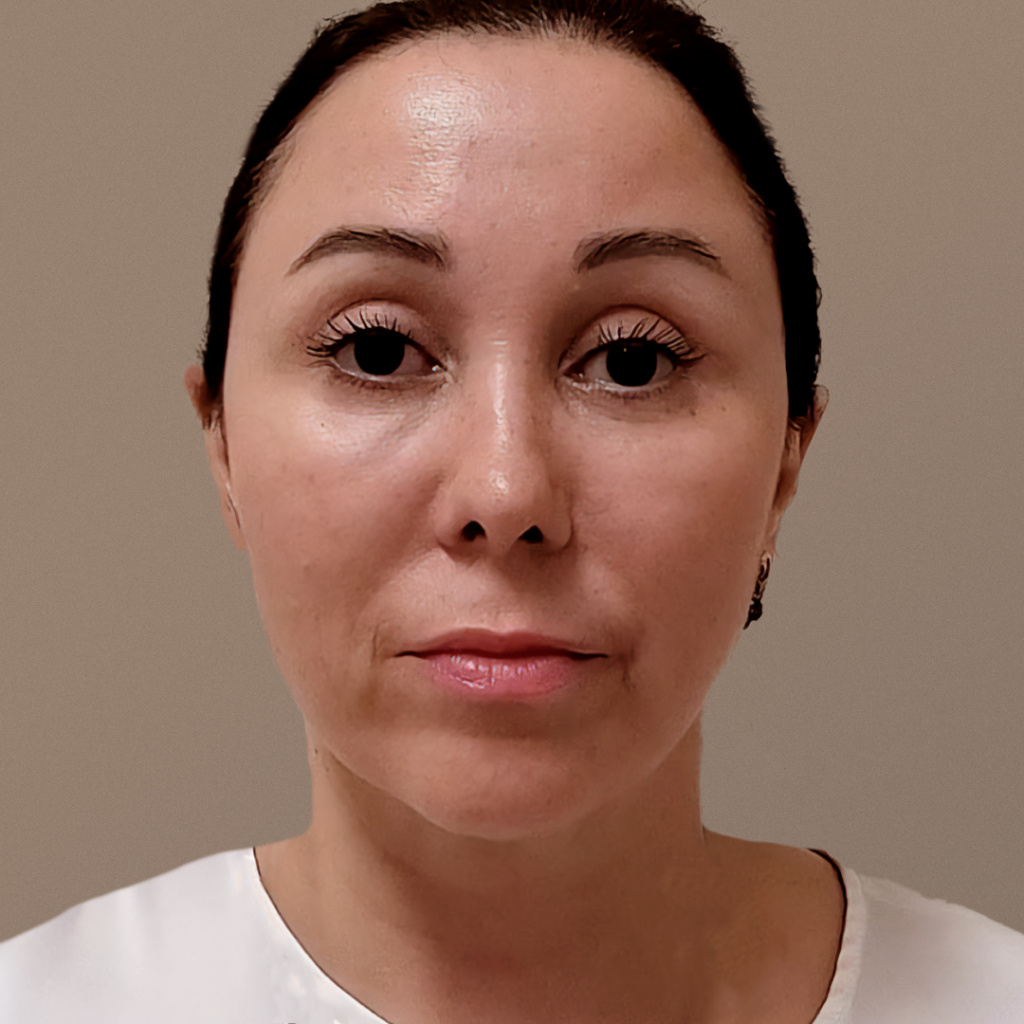 ПХ. Мусафиров. Фейслифтинг, эндоскопический лифтинг, круговая блефаропластика, коррекция кончика носа 6