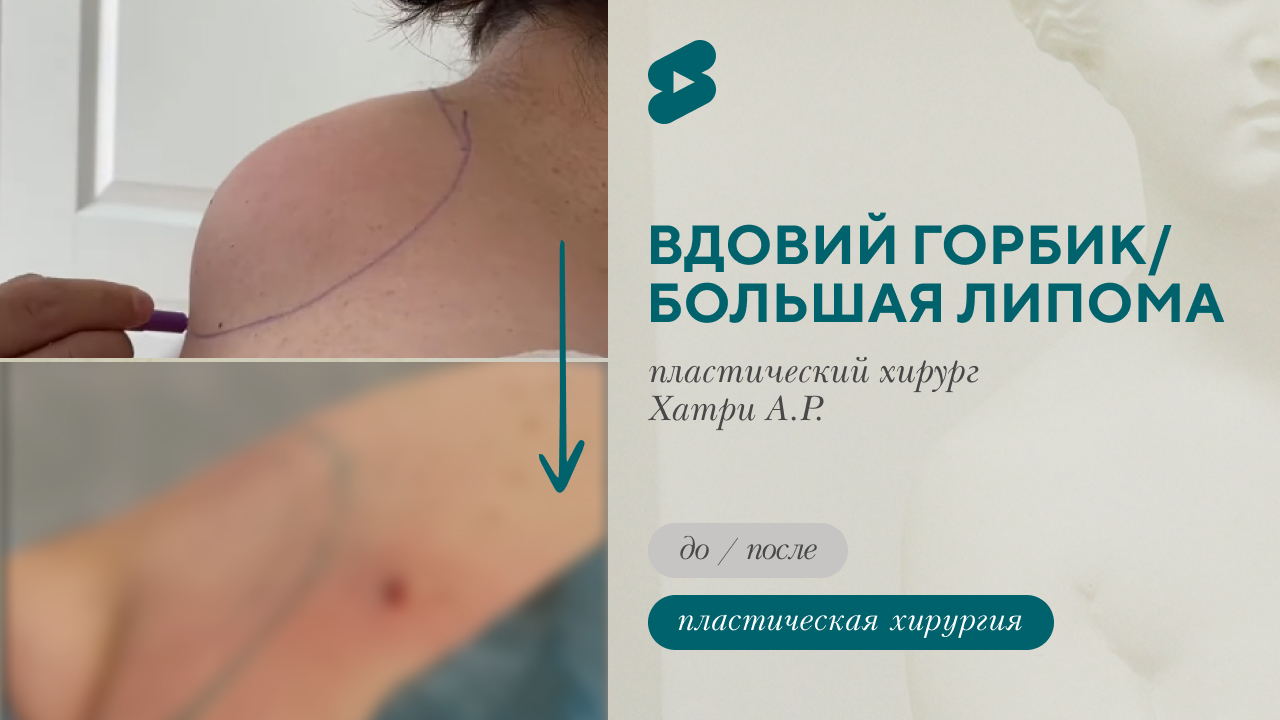 Вдовий горбик, большая липома. Аппарат VASER. (Хатри А.Р.)