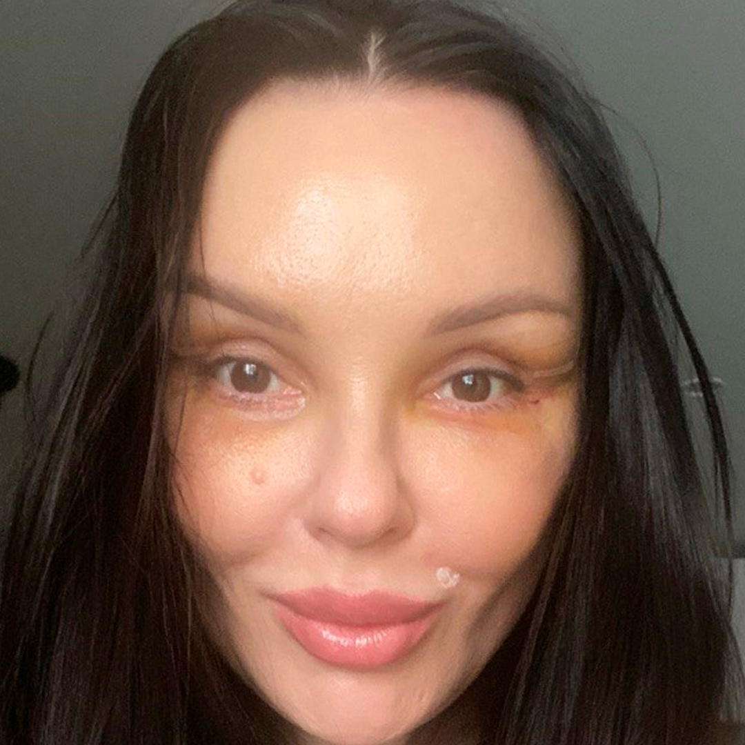 Реабилитация после блефаропластики, <br>6 день