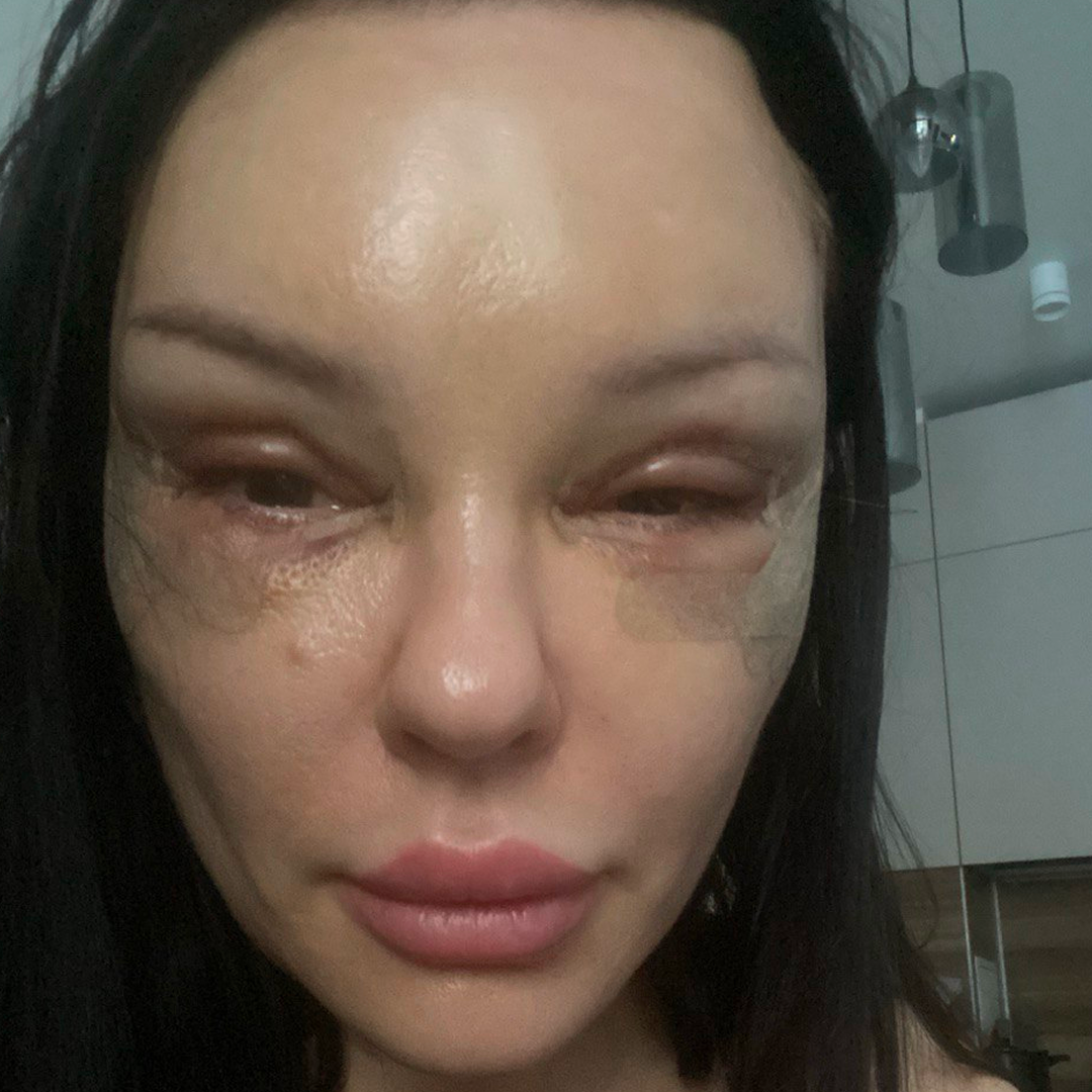 Реабилитация после блефаропластики, <br>3 день