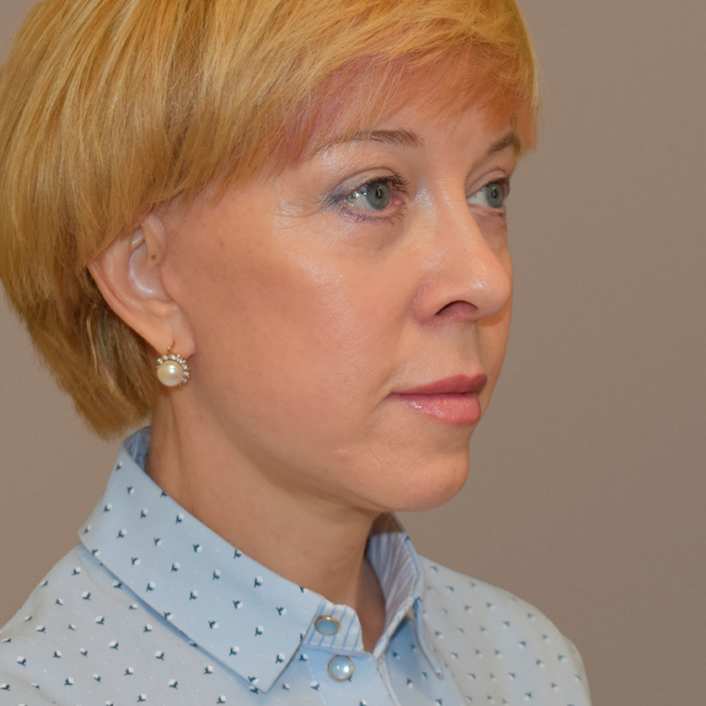 ПХ. Парыгин. Комплексное омоложение. Подтяжка лица, фейслифтинг, платизмопластика, блефаропластика, лобэндоскопия 1