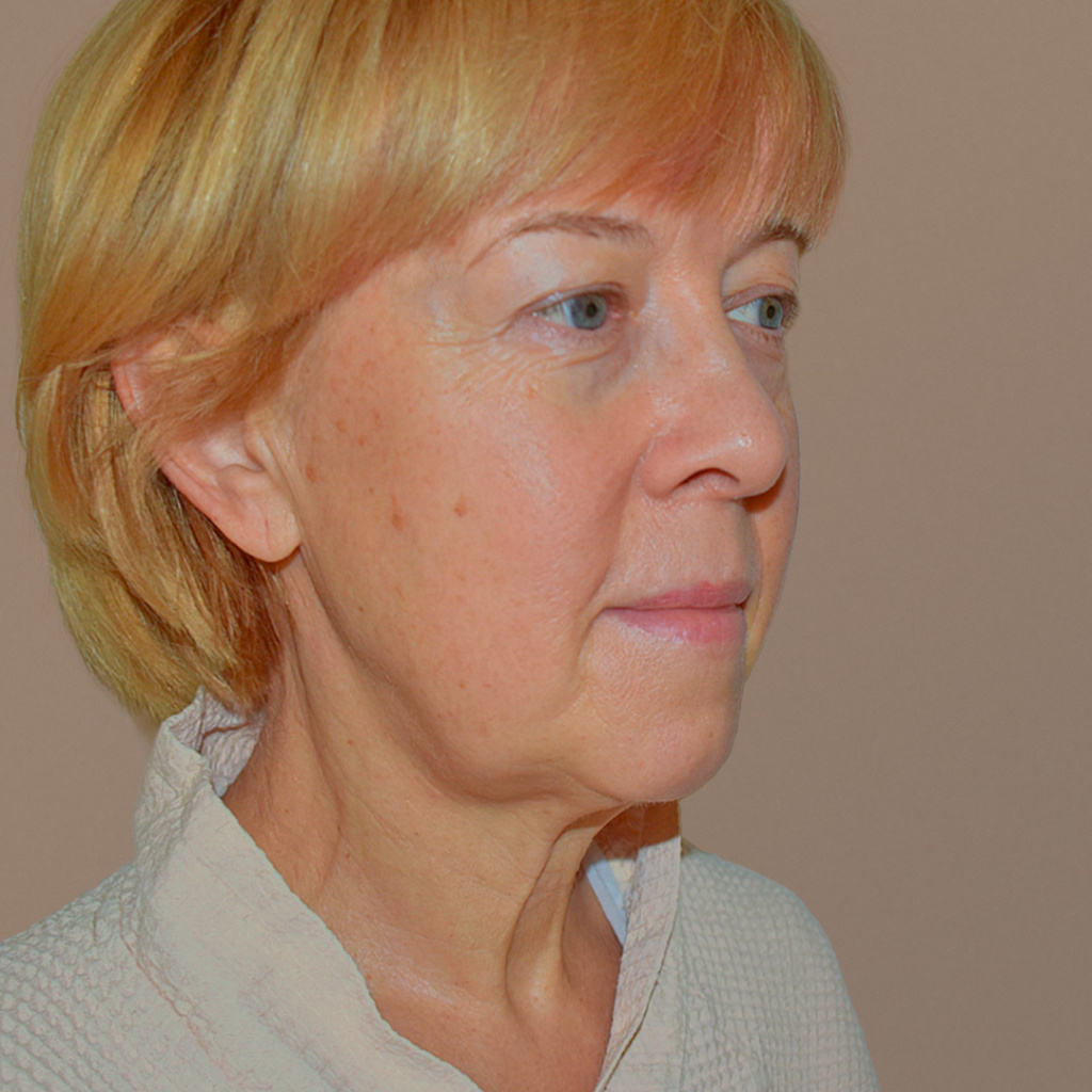 ПХ. Парыгин. Комплексное омоложение. Подтяжка лица, фейслифтинг, платизмопластика, блефаропластика, лобэндоскопия 1