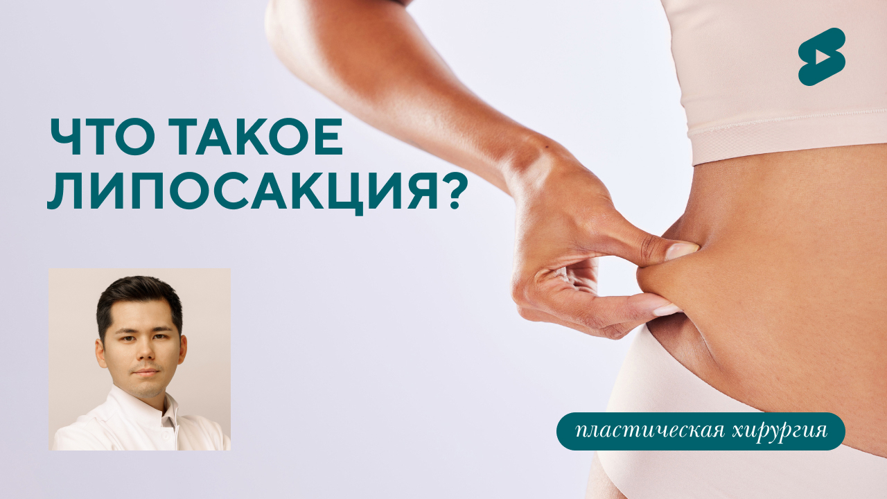 Что такое липосакция и кому она нужна. (Бударин М.С.)
