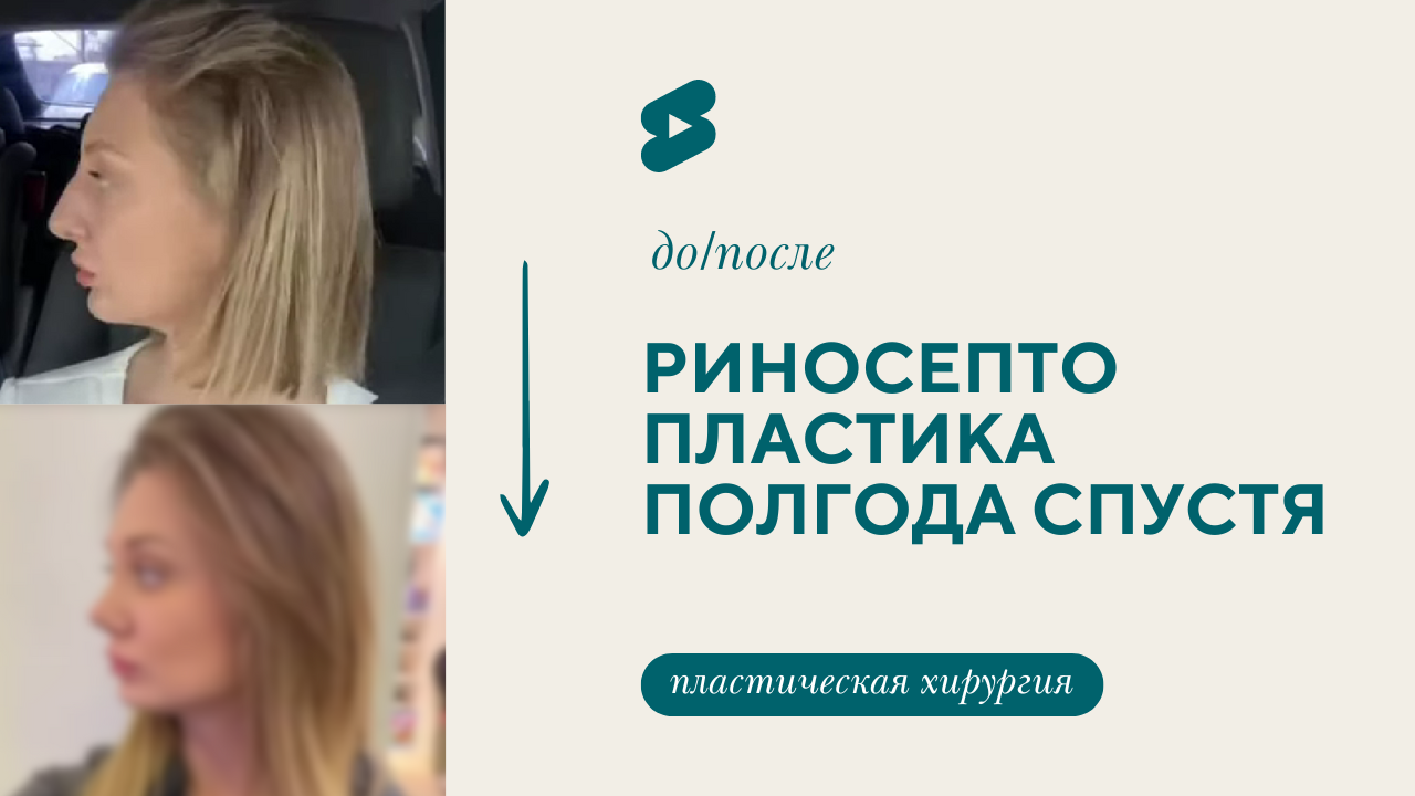 Риносептопластика полгода спустя (Барсаков М.А.)